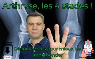 Arthrose, quels sont les 4 stades ?